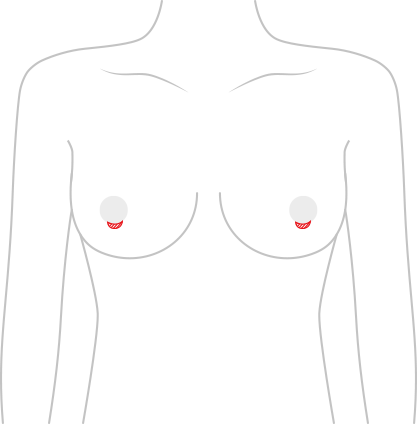 Breast revision surgery