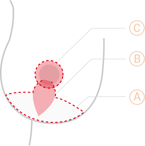 Motiva breast augmentation