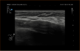 Healthy Breast Implant Ultrasound img10 m