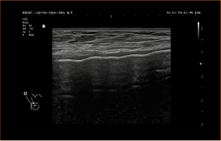 Healthy Breast Implant Ultrasound img11 m