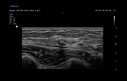 Healthy Breast Implant Ultrasound img5 m