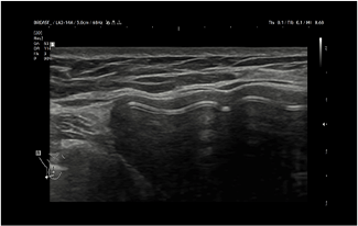 Healthy Breast Implant Ultrasound img6 m