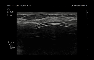 Healthy Breast Implant Ultrasound img7 m