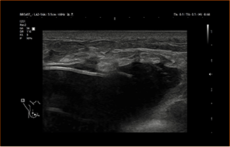 Healthy Breast Implant Ultrasound img8 m