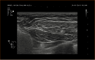Healthy Breast Implant Ultrasound img9 m