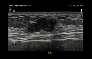 Healthy Breast Breast Cancer Ultrasound img10 m