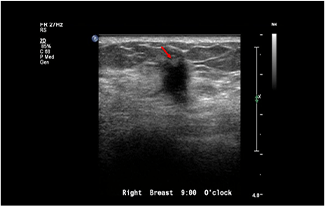 Healthy Breast Breast Cancer Ultrasound img11 m