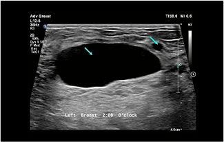 Healthy Breast Breast Cancer Ultrasound img12 m