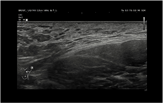 Healthy Breast Breast Cancer Ultrasound img13 m
