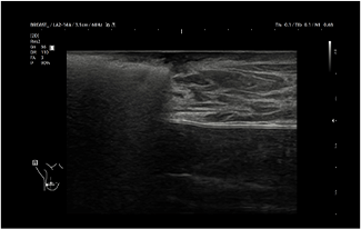 Healthy Breast Breast Cancer Ultrasound img14 m