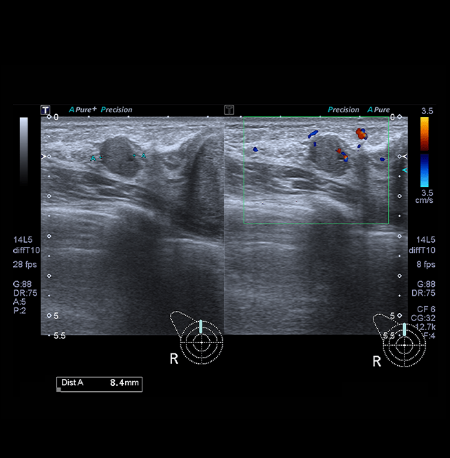 Healthy Breast Breast Cancer Ultrasound img17 m