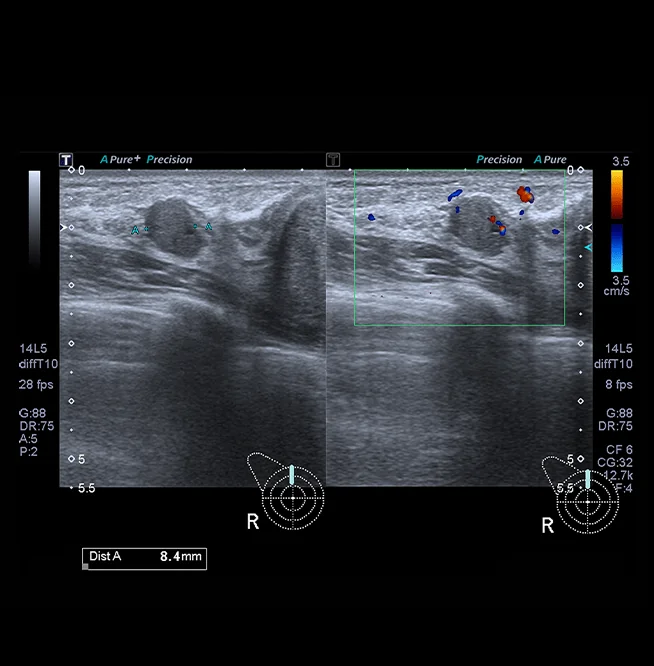 Healthy Breast Breast Cancer Ultrasound img17 m