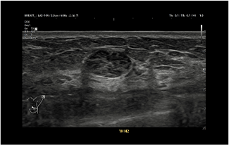 Healthy Breast Breast Cancer Ultrasound img9 m