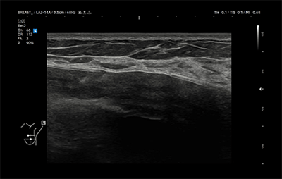 healthy breast implant ultrasound img10