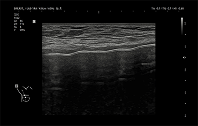healthy breast implant ultrasound img11