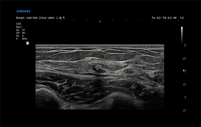 healthy breast implant ultrasound img5