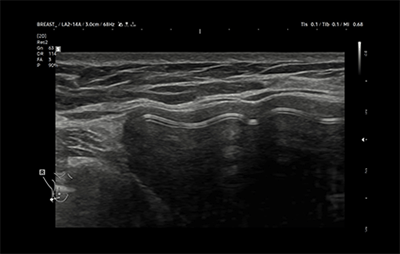 healthy breast implant ultrasound img6