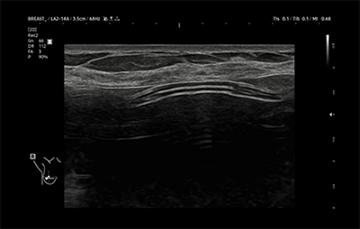 healthy breast implant ultrasound img7