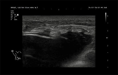 healthy breast implant ultrasound img8
