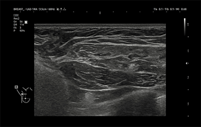 healthy breast implant ultrasound img9