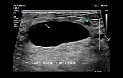 healthy breast breast cancer ultrasound img10