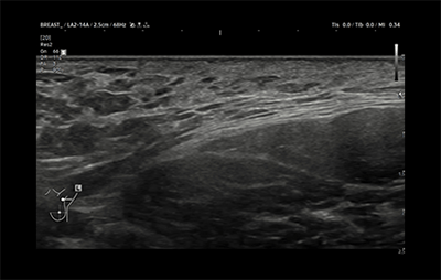 healthy breast breast cancer ultrasound img11