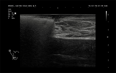 healthy breast breast cancer ultrasound img12