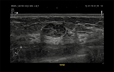 healthy breast breast cancer ultrasound img7