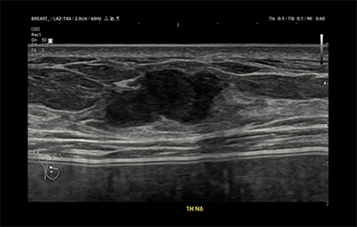 healthy breast breast cancer ultrasound img8