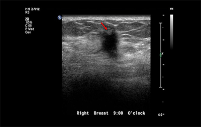 healthy breast breast cancer ultrasound img9